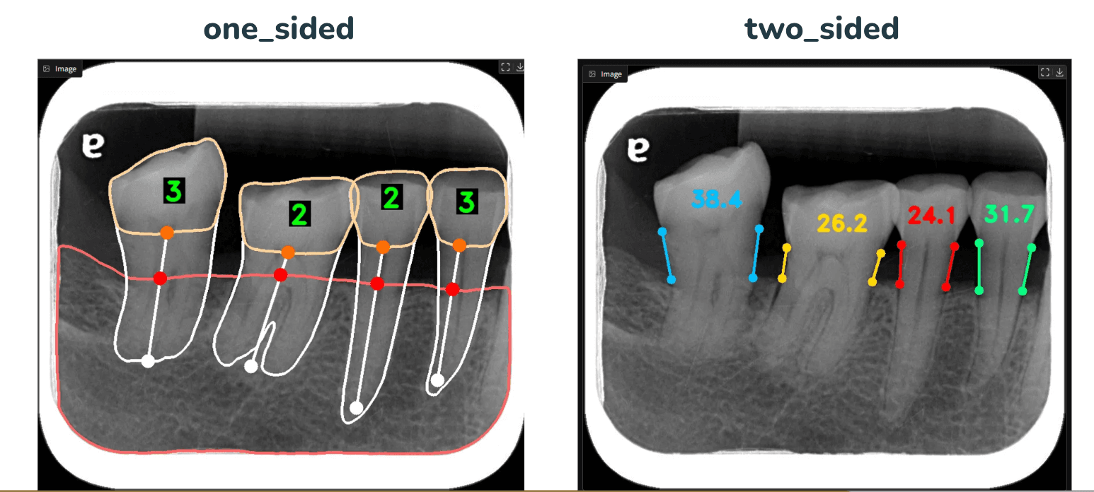 牙科 X 光 AI 分析畫面